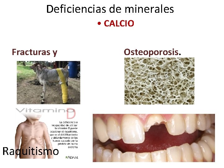 Deficiencias de minerales • CALCIO Fracturas y Raquitismo Osteoporosis. 