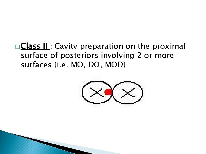 � Class II : Cavity preparation on the proximal surface of posteriors involving 2