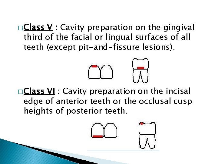 � Class V : Cavity preparation on the gingival third of the facial or