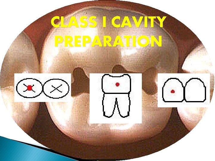 CLASS I CAVITY PREPARATION 