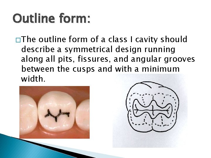 Outline form: � The outline form of a class I cavity should describe a
