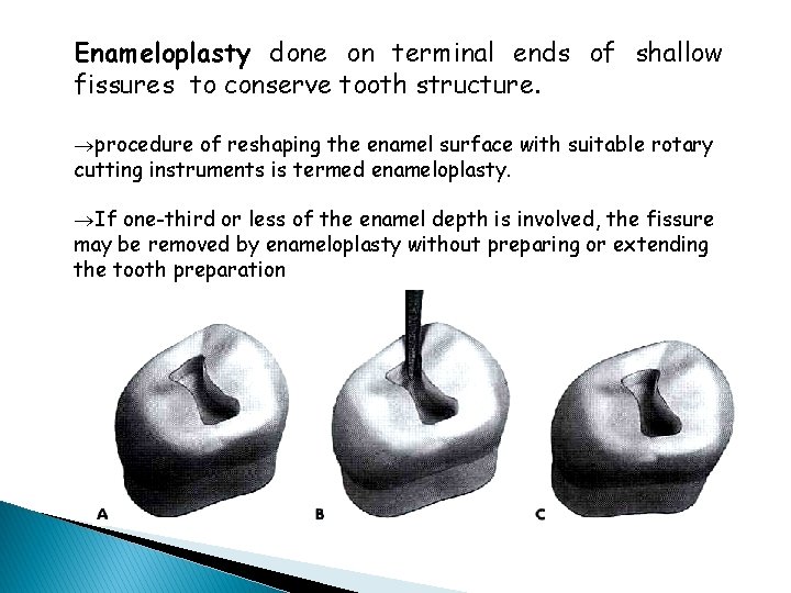 Enameloplasty done on terminal ends of shallow fissures to conserve tooth structure. ®procedure of