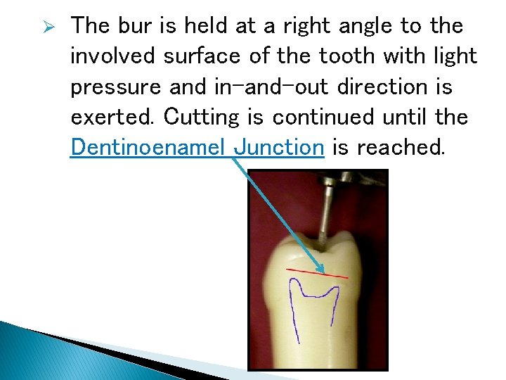Ø The bur is held at a right angle to the involved surface of