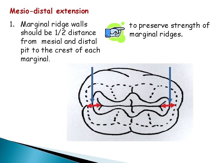 Mesio-distal extension 1. Marginal ridge walls should be 1/2 distance from mesial and distal