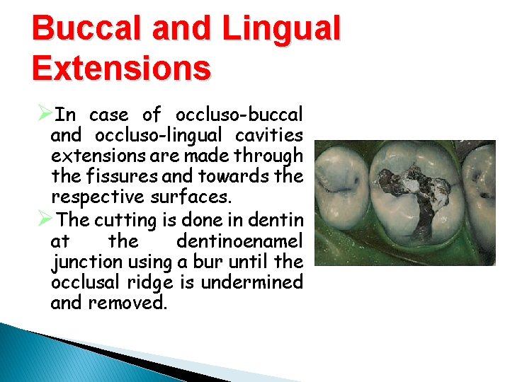 Buccal and Lingual Extensions ØIn case of occluso-buccal and occluso-lingual cavities extensions are made