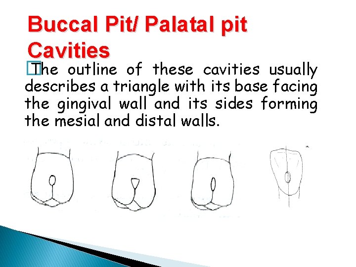 Buccal Pit/ Palatal pit Cavities � The outline of these cavities usually describes a