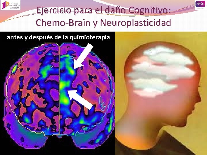 Ejercicio para el daño Cognitivo: Chemo-Brain y Neuroplasticidad antes y después de la quimioterapia