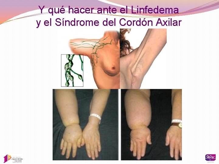 Y qué hacer ante el Linfedema y el Síndrome del Cordón Axilar 