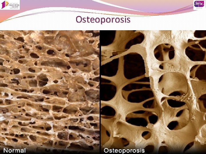 Osteoporosis 
