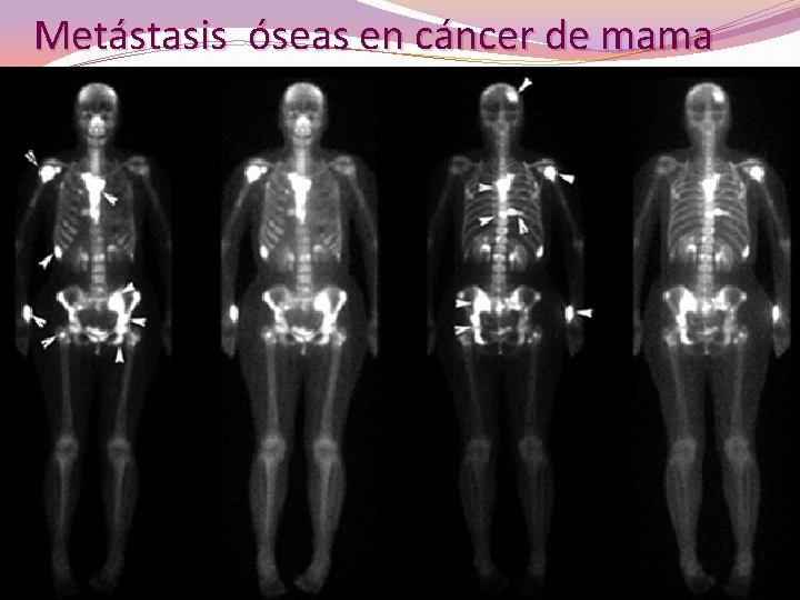 Metástasis óseas en cáncer de mama 