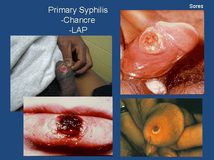 Primary Syphilis -Chancre -LAP Sores 11 