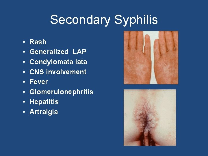 Secondary Syphilis • • Rash Generalized LAP Condylomata lata CNS involvement Fever Glomerulonephritis Hepatitis