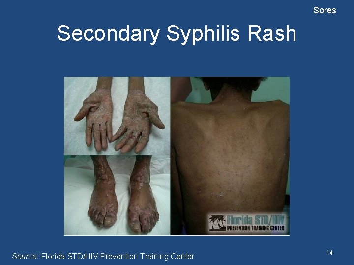 Sores Secondary Syphilis Rash Source: Florida STD/HIV Prevention Training Center 14 