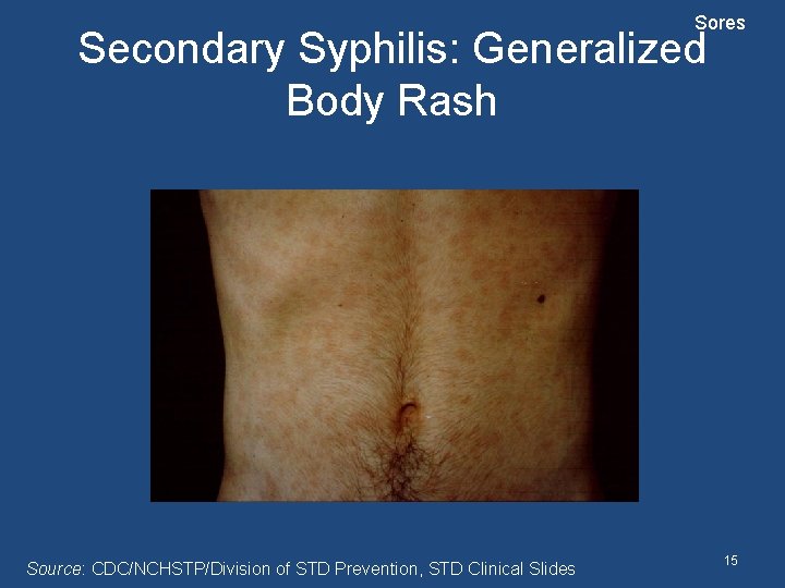 Sores Secondary Syphilis: Generalized Body Rash Source: CDC/NCHSTP/Division of STD Prevention, STD Clinical Slides