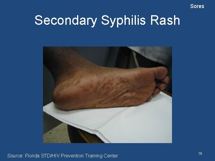 Sores Secondary Syphilis Rash Source: Florida STD/HIV Prevention Training Center 16 