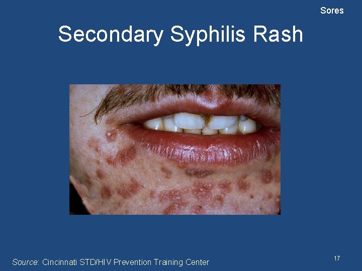 Sores Secondary Syphilis Rash Source: Cincinnati STD/HIV Prevention Training Center 17 