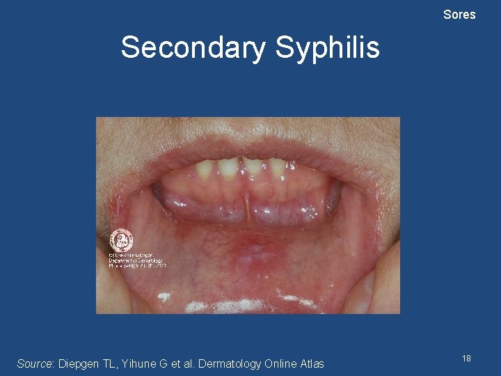 Sores Secondary Syphilis Source: Diepgen TL, Yihune G et al. Dermatology Online Atlas 18