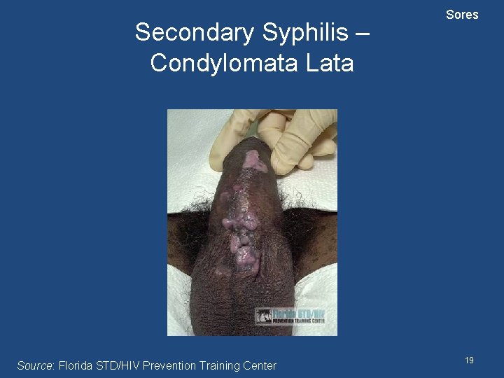 Secondary Syphilis – Condylomata Lata Source: Florida STD/HIV Prevention Training Center Sores 19 