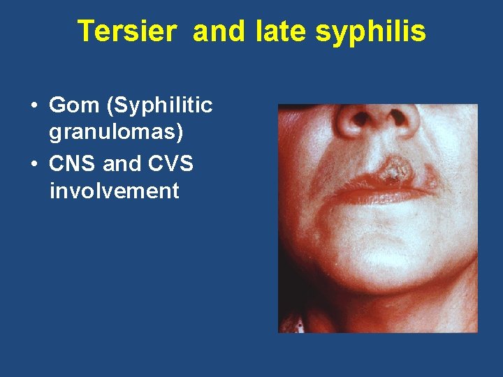 Tersier and late syphilis • Gom (Syphilitic granulomas) • CNS and CVS involvement 