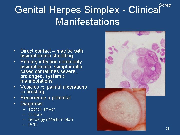 Sores Genital Herpes Simplex - Clinical Manifestations • Direct contact – may be with