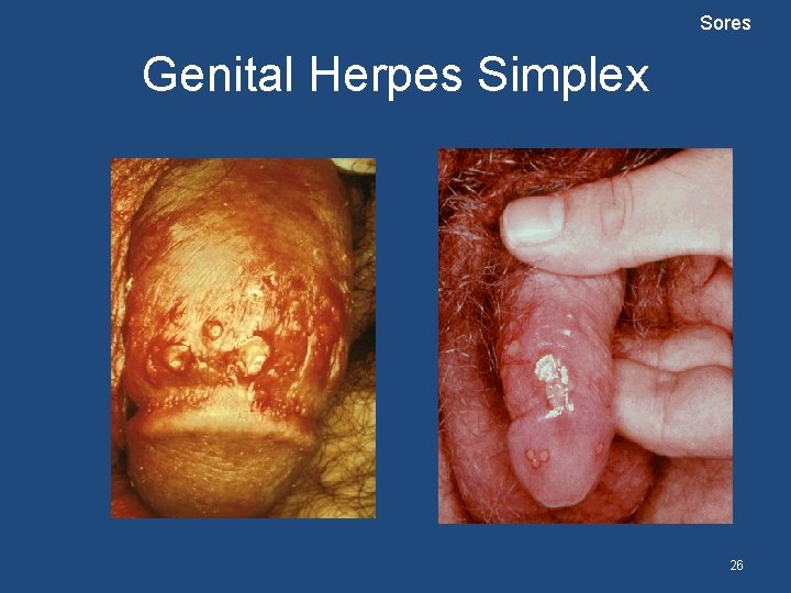 Sores Genital Herpes Simplex 26 