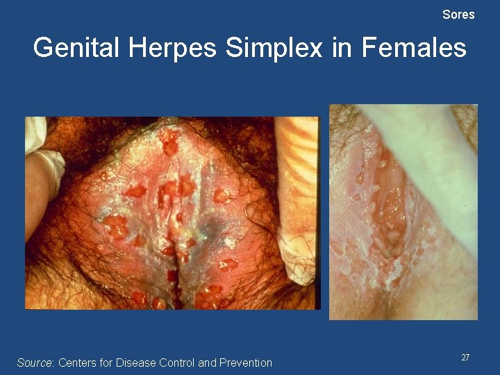 Sores Genital Herpes Simplex in Females Source: Centers for Disease Control and Prevention 27