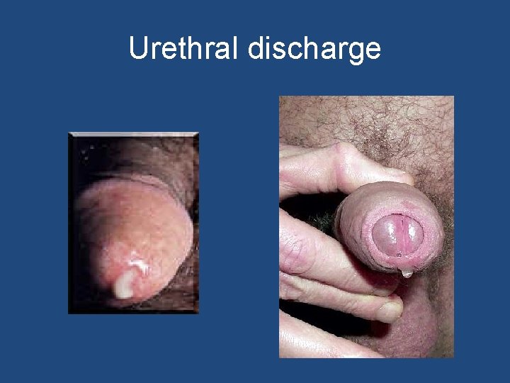 Urethral discharge 