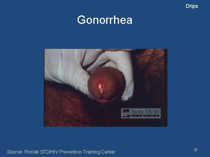 Drips Gonorrhea Source: Florida STD/HIV Prevention Training Center 32 