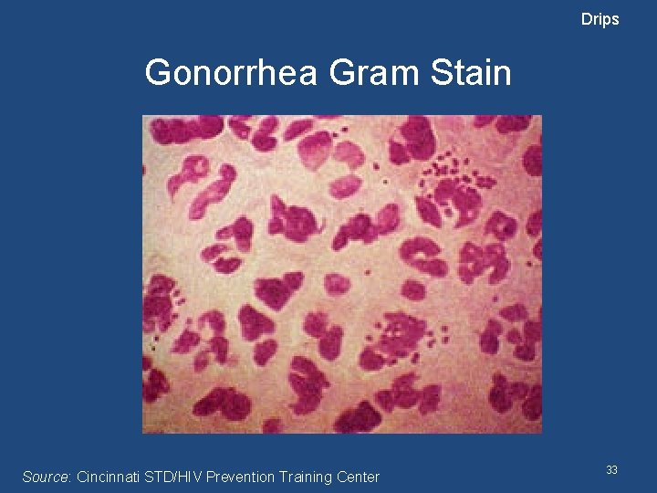 Drips Gonorrhea Gram Stain Source: Cincinnati STD/HIV Prevention Training Center 33 