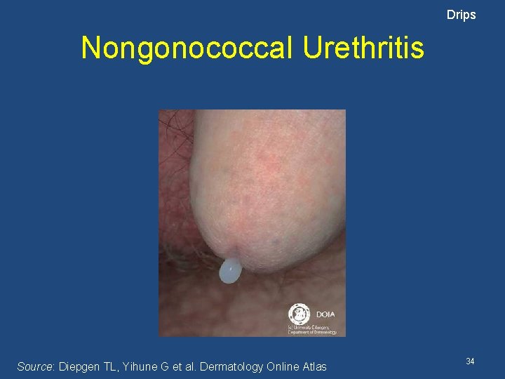 Drips Nongonococcal Urethritis Source: Diepgen TL, Yihune G et al. Dermatology Online Atlas 34