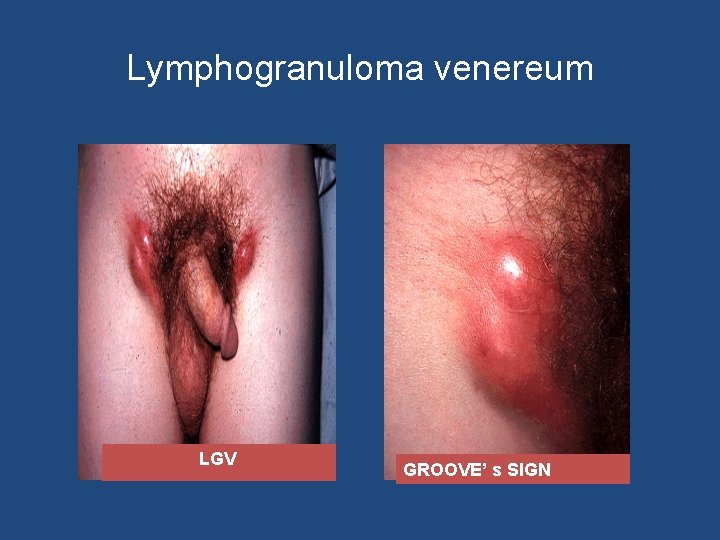 Lymphogranuloma venereum LGV GROOVE’ s SIGN 
