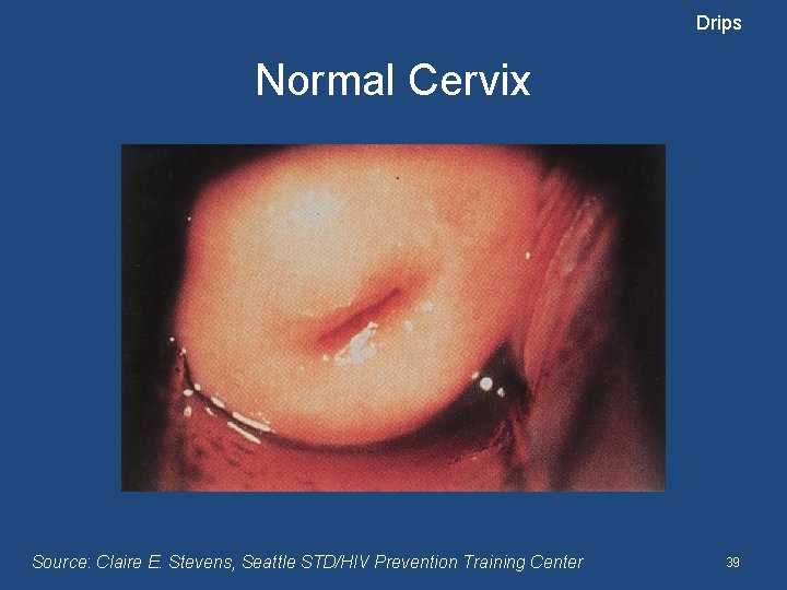 Drips Normal Cervix Source: Claire E. Stevens, Seattle STD/HIV Prevention Training Center 39 