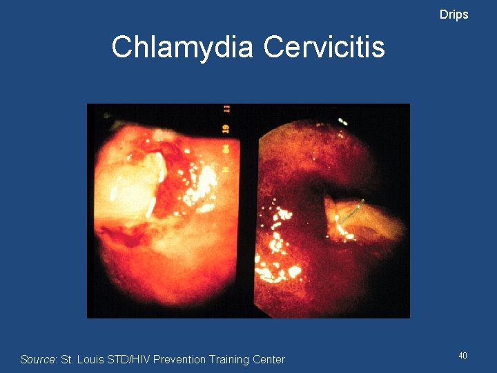 Drips Chlamydia Cervicitis Source: St. Louis STD/HIV Prevention Training Center 40 