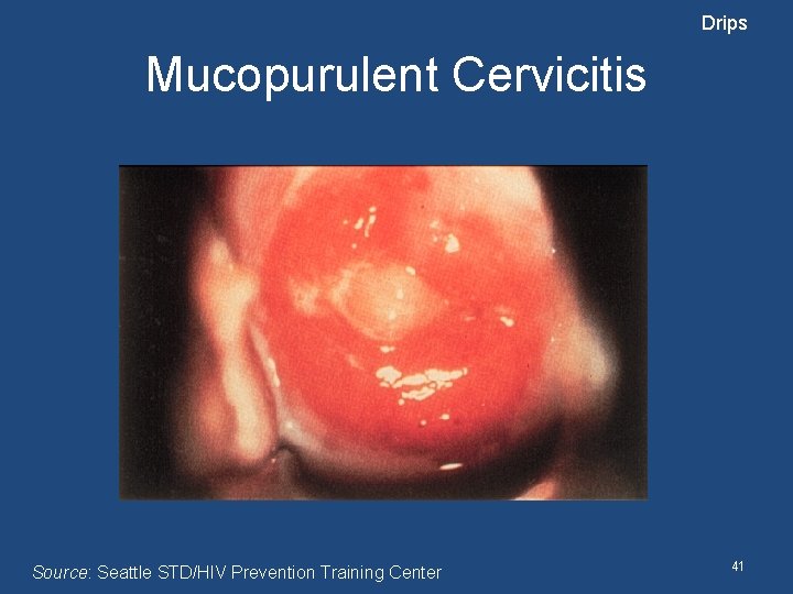 Drips Mucopurulent Cervicitis Source: Seattle STD/HIV Prevention Training Center 41 