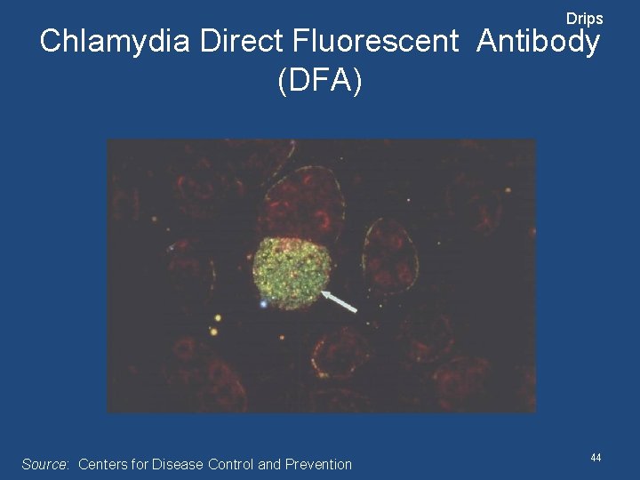 Drips Chlamydia Direct Fluorescent Antibody (DFA) Source: Centers for Disease Control and Prevention 44
