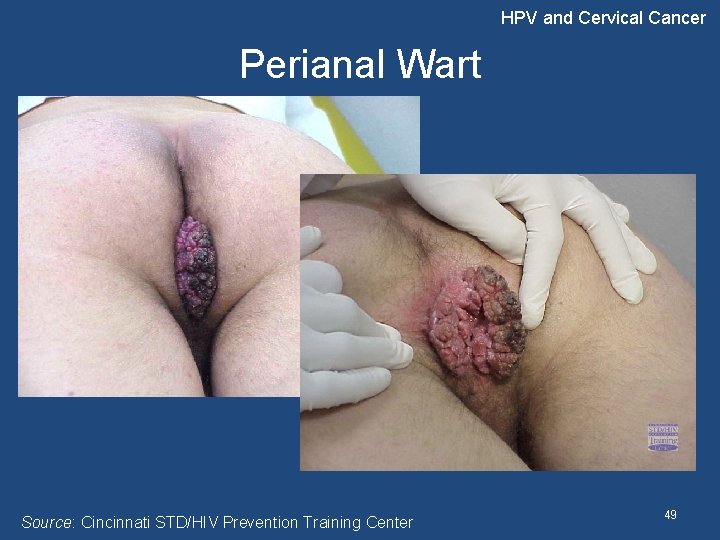 HPV and Cervical Cancer Perianal Wart Source: Cincinnati STD/HIV Prevention Training Center 49 