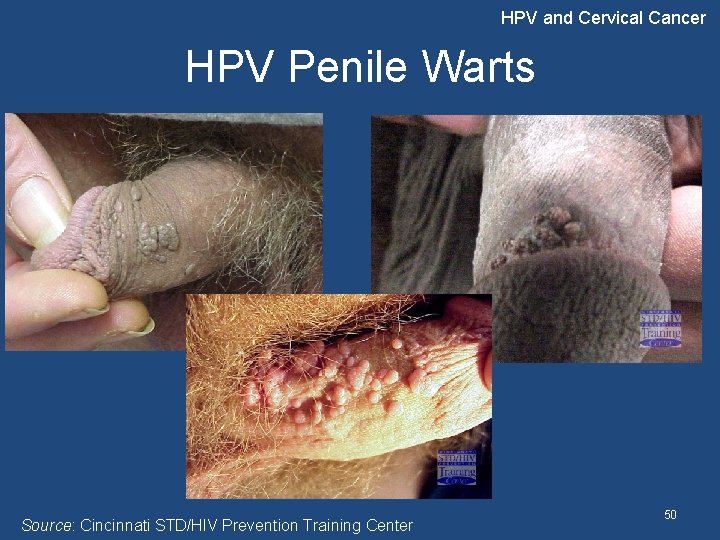 HPV and Cervical Cancer HPV Penile Warts Source: Cincinnati STD/HIV Prevention Training Center 50