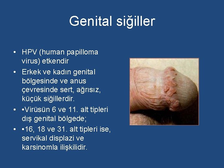 Genital siğiller • HPV (human papilloma virus) etkendir • Erkek ve kadın genital bölgesinde