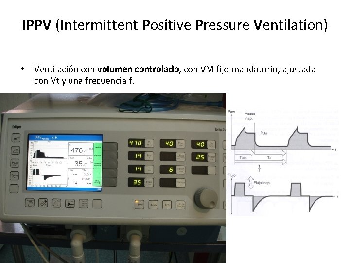 IPPV (Intermittent Positive Pressure Ventilation) • Ventilación con volumen controlado, con VM fijo mandatorio,