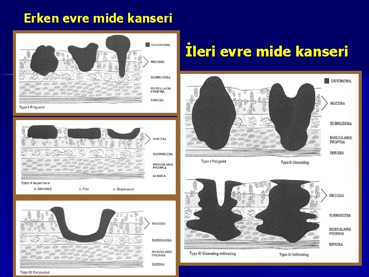 Erken evre mide kanseri İleri evre mide kanseri 