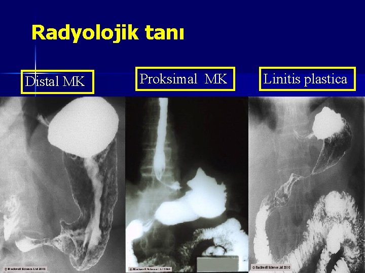 Radyolojik tanı Distal MK Proksimal MK Linitis plastica 