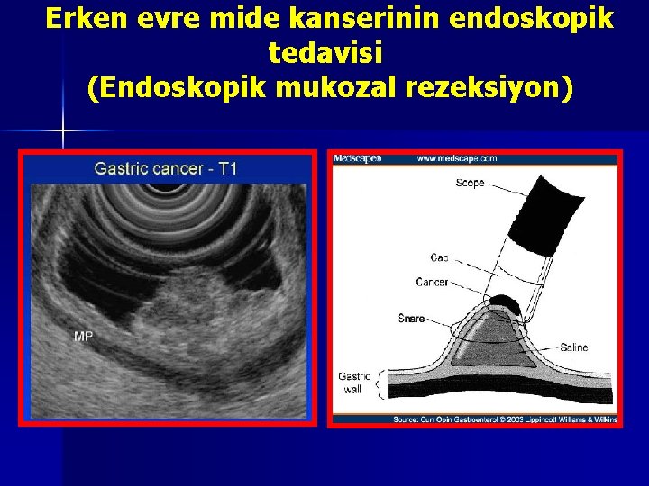 Erken evre mide kanserinin endoskopik tedavisi (Endoskopik mukozal rezeksiyon) Gastric cancer lesion confined to