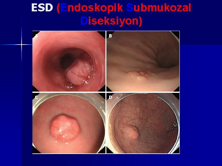 ESD (Endoskopik Submukozal Diseksiyon) 