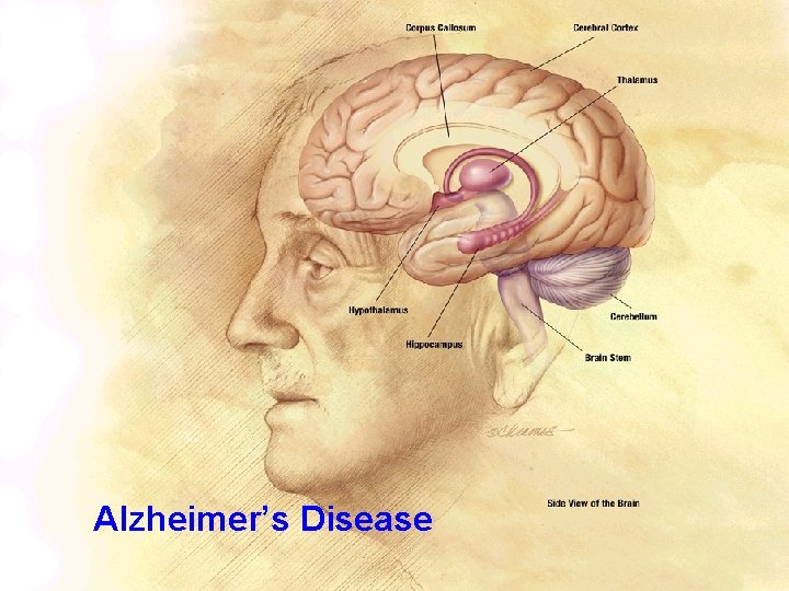 Alzheimer’s Disease UISU 2011 -2 