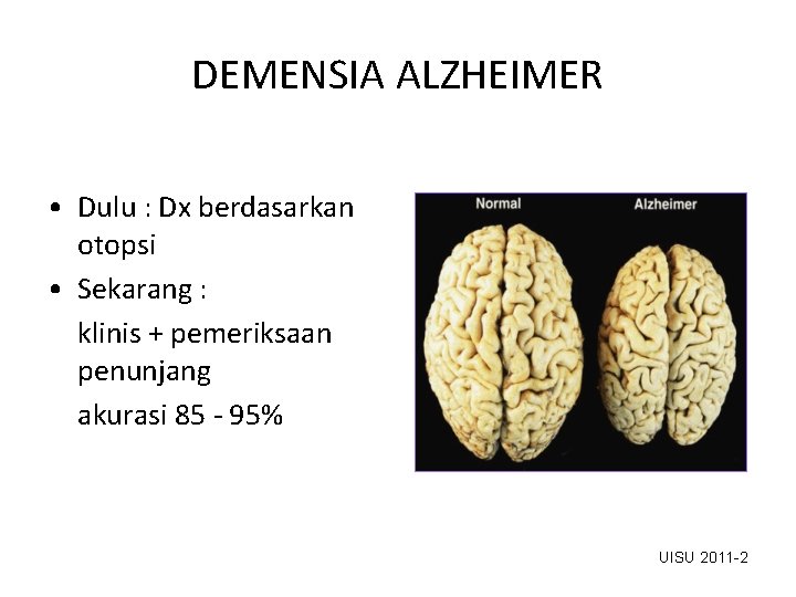 DEMENSIA ALZHEIMER • Dulu : Dx berdasarkan otopsi • Sekarang : klinis + pemeriksaan