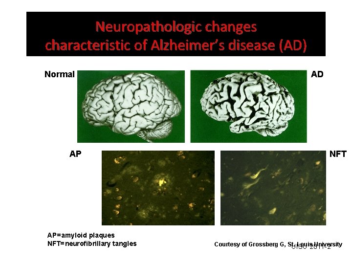 Neuropathologic changes characteristic of Alzheimer’s disease (AD) Normal AP AP=amyloid plaques NFT=neurofibrillary tangles AD