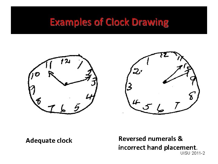 Examples of Clock Drawing Adequate clock Reversed numerals & incorrect hand placement. UISU 2011