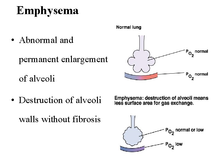 Emphysema • Abnormal and permanent enlargement of alveoli • Destruction of alveoli walls without