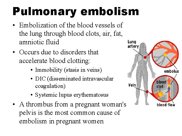 Pulmonary embolism • Embolization of the blood vessels of the lung through blood clots,