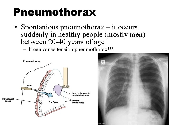 Pneumothorax • Spontanious pneumothorax – it occurs suddenly in healthy people (mostly men) between